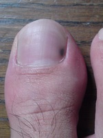 足親指爪1