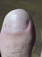 足親指爪2